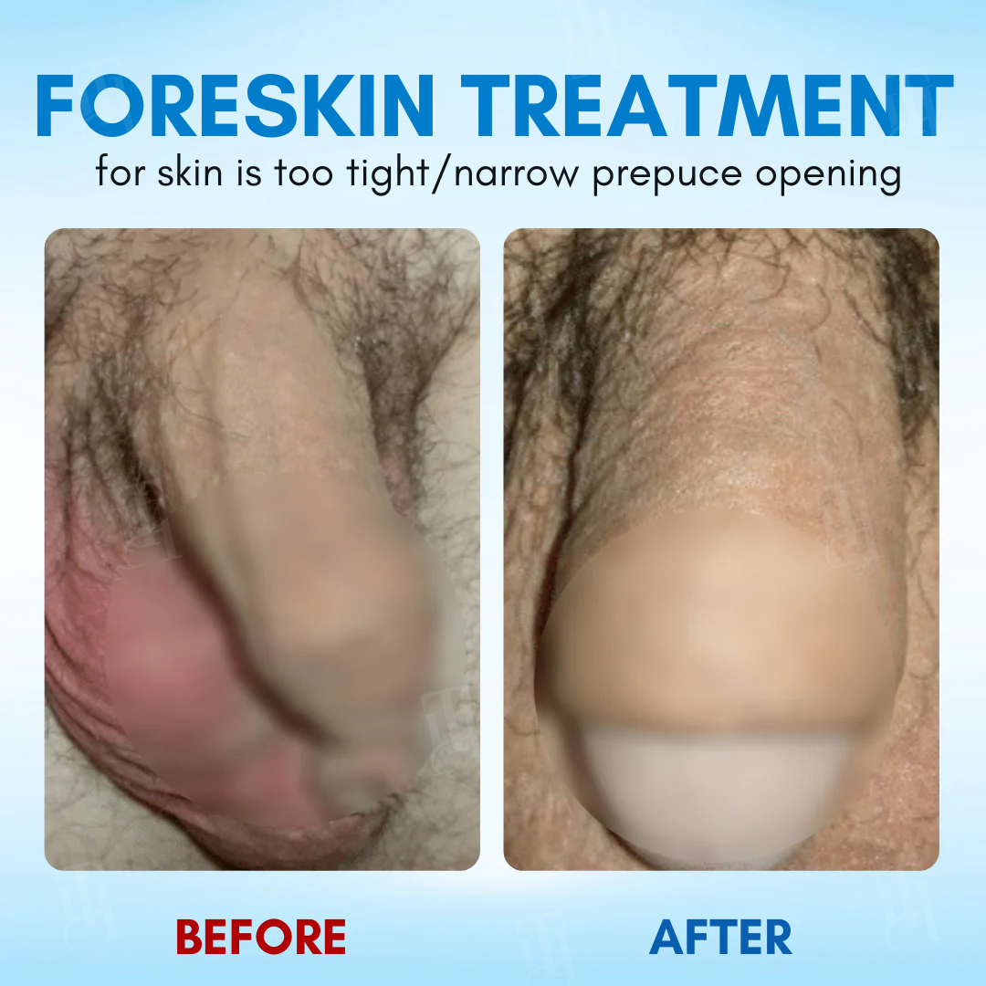 Limited Stock!!! RZXEA™ Foreskin Elasticity Gel: Restore Your Edge, Restart Your Vitality.
