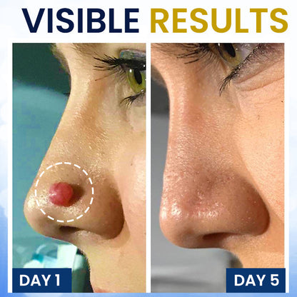 AEXZR® Cryotherapy Spray: Rapid removal of warts and calluses - visible results in 7 days ✨